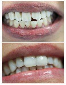 Chipped front tooth veneer