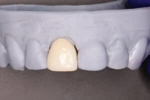 front tooth crown