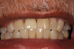 after photo porcelain crown
