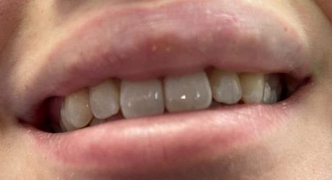 Emergency tooth repair with bonding