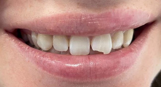 Dental Emergency - broken tooth
